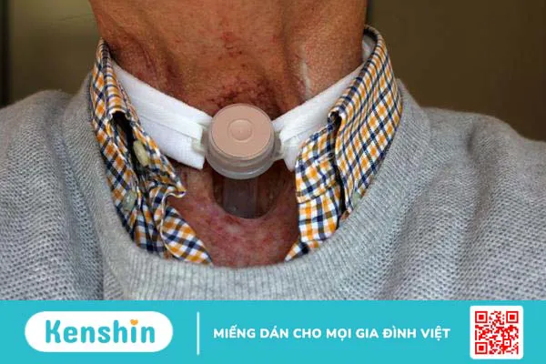 Khai khí quản là gì? Những điều cần biết về khai khí quản 3