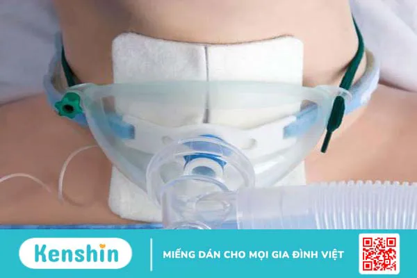 Khai khí quản là gì? Những điều cần biết về khai khí quản 3