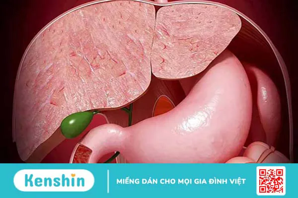 Khi nào cần mổ túi mật? Những thông tin cần biết 2