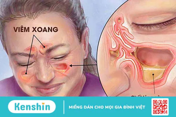 Khứu giác là gì? Những bệnh lý nào ảnh hưởng đến khứu giác? 3