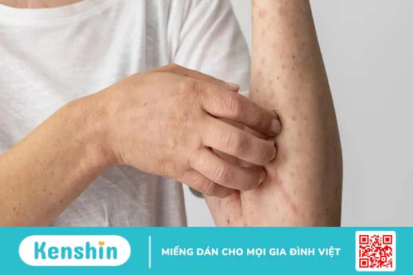 Làm sao để không bị lây thủy đậu?