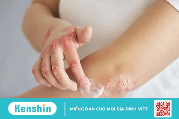 Làm sao để không bị lây thủy đậu?