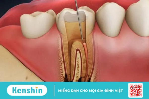 Lấy tủy răng bọc sứ giá bao nhiêu? Bảng giá mới nhất 1