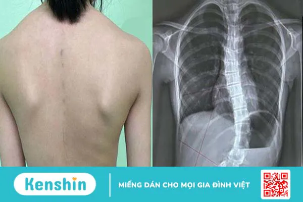 Lo lắng vẹo cột sống tự phát ở trẻ em 1