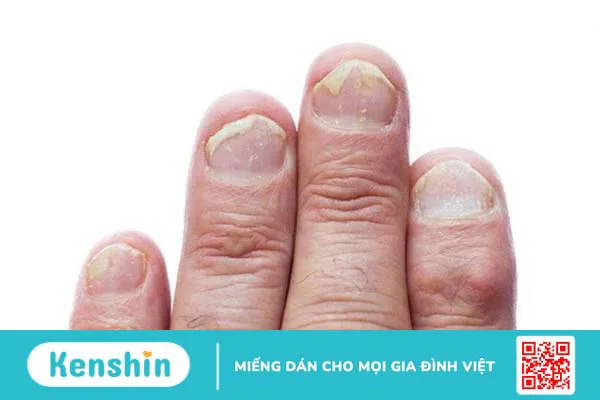 Loạn dưỡng móng và những điều cần biết 1