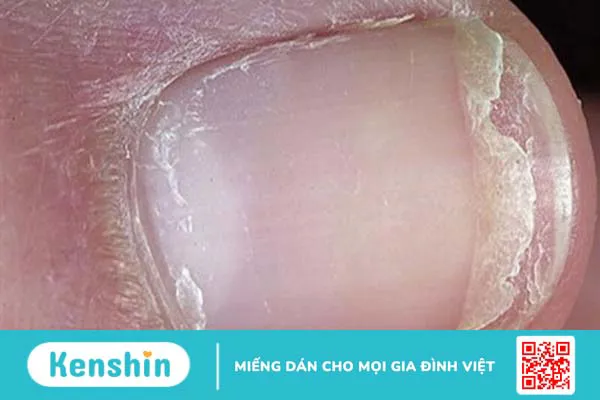 Loạn dưỡng móng và những điều cần biết 2