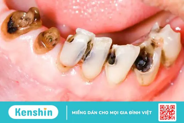 Lợi thừa ở răng hàm phải làm sao?