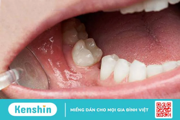 Lợi thừa ở răng hàm phải làm sao?