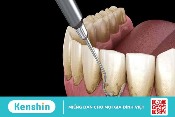 Lợi thừa ở răng hàm phải làm sao?