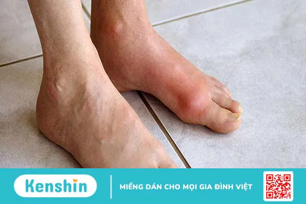 Mách bạn cách chữa bệnh gút ở chân hiệu quả 1