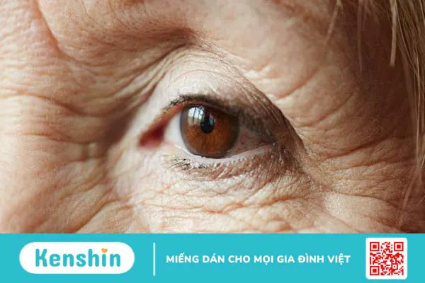 thoai-hoa-diem-vang-macular-degeneration-la-gi 1