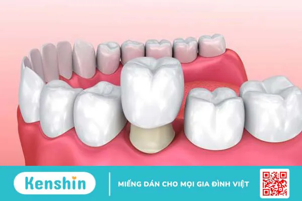 Mài răng bọc sứ, răng thật có bị yếu đi không?2