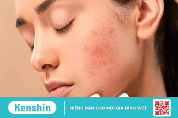 Mặt nạ đất sét có tác dụng gì? 4