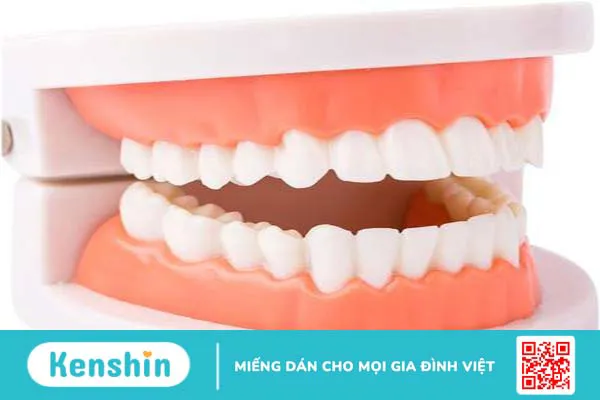 Mất răng có niềng răng được không? Giải pháp tối ưu nhất khi bị mất răng 1