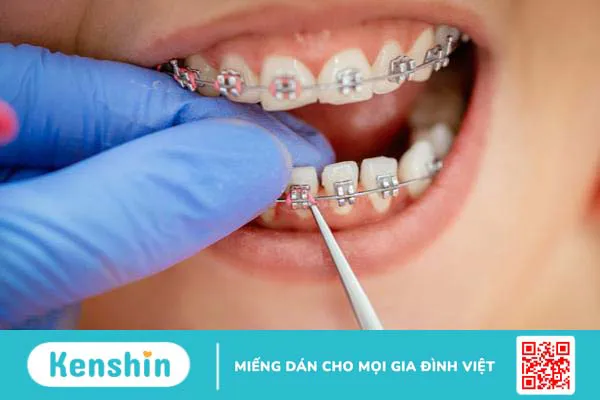 Mất răng có niềng răng được không? Giải pháp tối ưu nhất khi bị mất răng 3