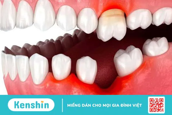 Mất răng số 6 có niềng răng được không? 1