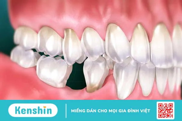 Mất răng số 6 có niềng răng được không? 2