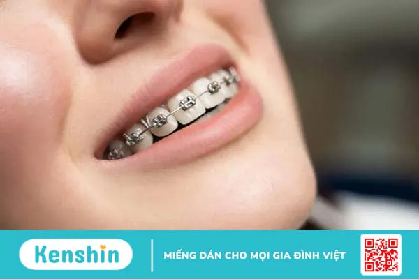 Mất răng số 6 có niềng răng được không? 3