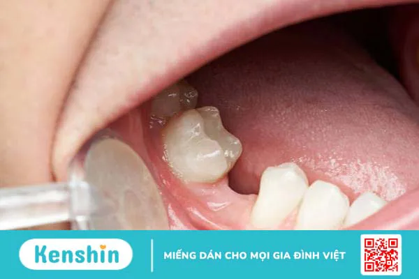 Mất răng số 7 hàm trên gây ra các bệnh lý gì cho răng miệng? 1