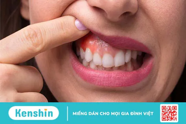 Mất răng số 7 hàm trên gây ra các bệnh lý gì cho răng miệng? 2