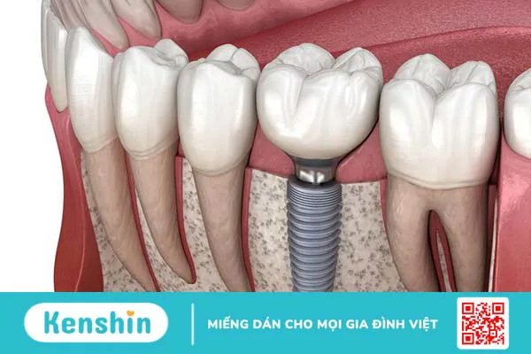 Mất răng số 7 hàm trên gây ra các bệnh lý gì cho răng miệng? 3