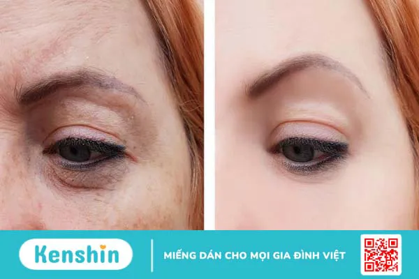 Mesotherapy là gì? Chỉ định và chống chỉ định thực hiện cần biết 2