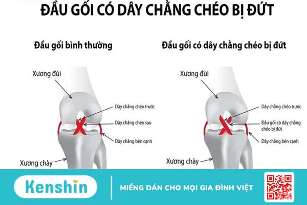 Mổ dây chằng chéo trước bao lâu thì bỏ nẹp? Chế độ tập luyện cho người bệnh đúng nhất 1