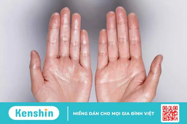 Mổ nội soi cắt hạch thần kinh giao cảm như thế nào để đảm bảo an toàn 1