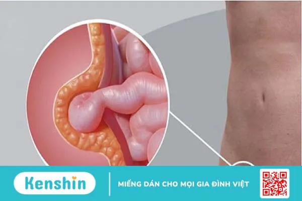 Mổ thoát vị bẹn ở đâu tốt nhất? Nên làm gì sau mổ? 1