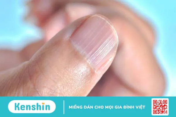 Giải đáp: Móng tay bị sần gợn sóng “cảnh báo” căn bệnh gì? 1