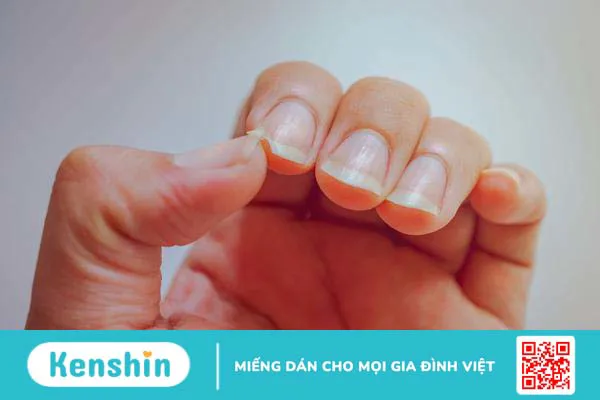 Giải đáp: Móng tay bị sần gợn sóng “cảnh báo” căn bệnh gì? 2