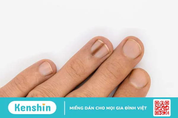 Giải đáp: Móng tay bị sần gợn sóng “cảnh báo” căn bệnh gì? 3