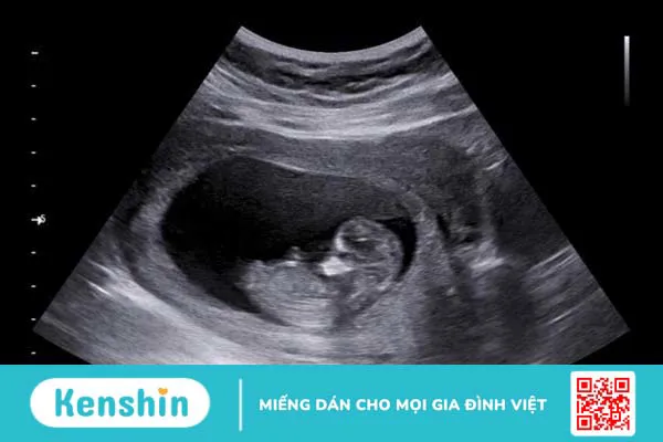 U cơ tim thai nhi có ảnh hưởng đến trẻ sau sinh? Cùng tìm hiểu về u cơ tim thai nhi1