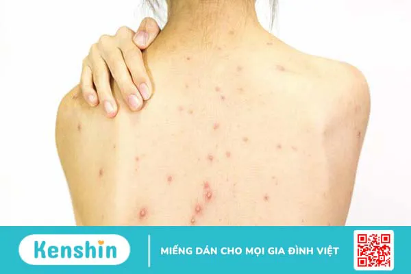 Nguyên nhân chính gây mụn ở lưng là do sự tắc nghẽn lỗ chân lông