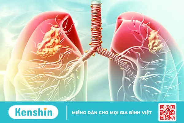 Mức độ nguy hiểm, nguyên nhân và triệu chứng hen phế quản ở trẻ em 1