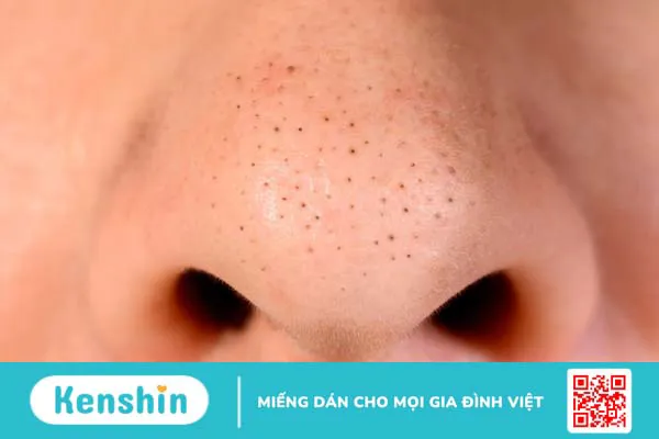 Mụn cám có nên nặn không? Một số lưu ý khi nặn mụn cám 3