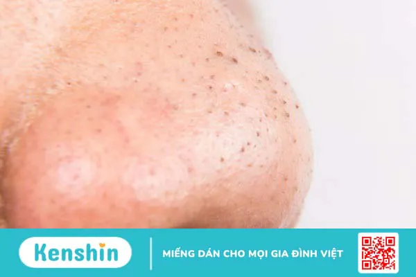 Mụn cám có nên nặn không? Một số lưu ý khi nặn mụn cám 2