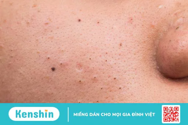 Mụn đầu đen ở má: Nguyên nhân hình thành và cách trị mụn 1