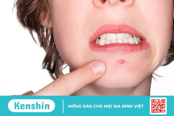 Mụn đinh râu có gây nguy hiểm hay không?