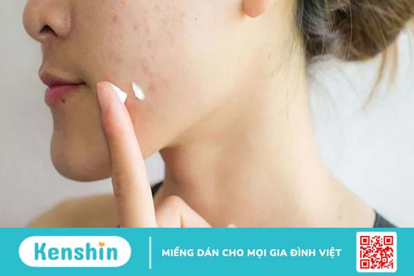 Mụn trứng cá mủ: Đặc điểm và cách điều trị khoa học 3