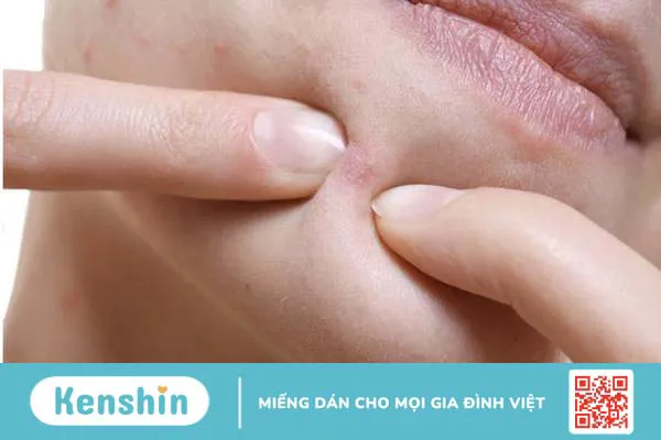 Nặn mụn bằng tăm bông và những điều cần biết 1