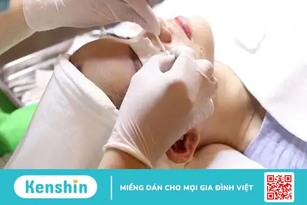 Nặn mụn bằng tăm bông và những điều cần biết 2