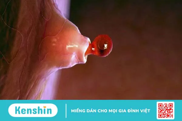 Nang trứng 12mm có thụ thai được không? 2