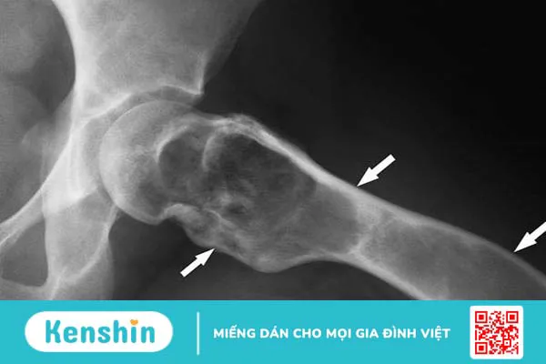 Nang xương phình mạch là gì? Điều trị thế nào? 3