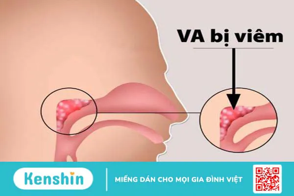 Góc giải đáp: Nạo VA cho trẻ liệu có gây đau?