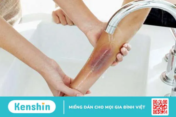 Nên làm gì khi bị bỏng nước sôi 1