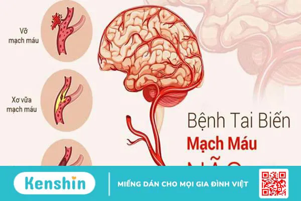 Người mắc bệnh tai biến mạch máu não nên ăn trái cây gì? 1