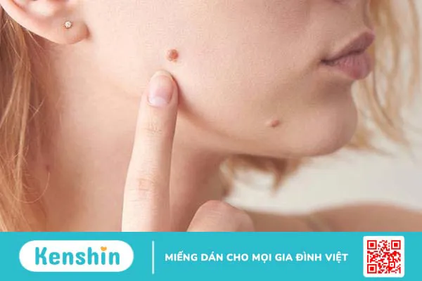 Người mắc bệnh ung thư da hắc tố sống được bao lâu? 3