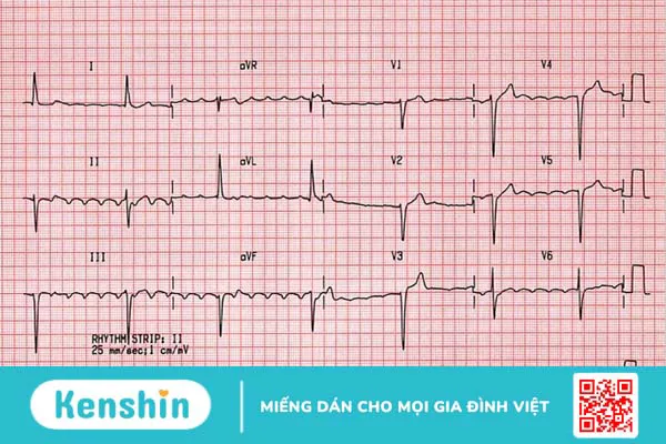 Nguy cơ đột tử khi bị block nhĩ thất độ 3 1