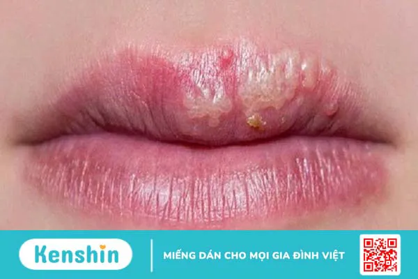 Nguyên nhân gây mọc mụn ở viền môi 1